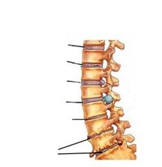 στάδια ανάπτυξης της οστεοχονδρωσίας